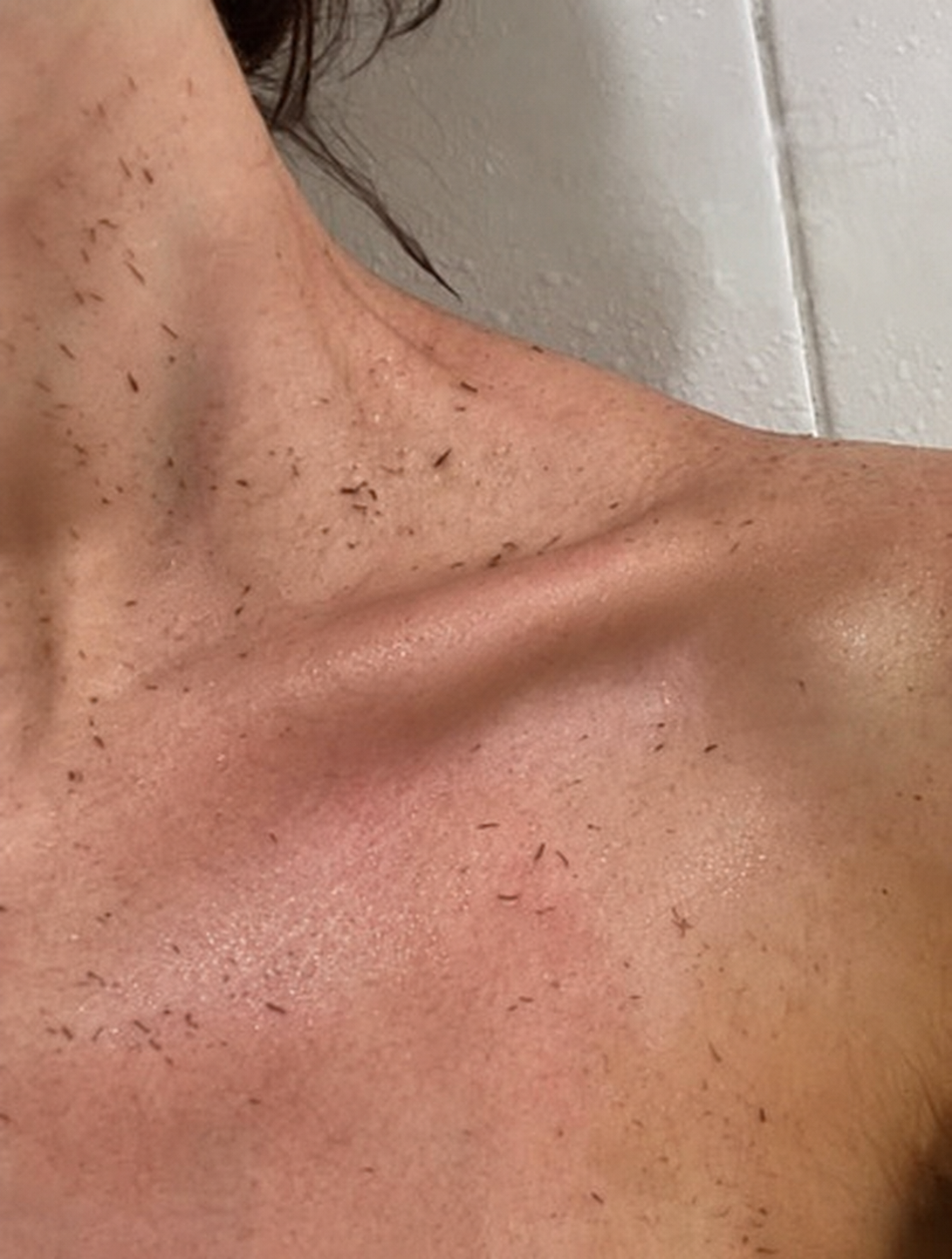 Dead skin lifted from a shoulder and collarbone after scrubbing