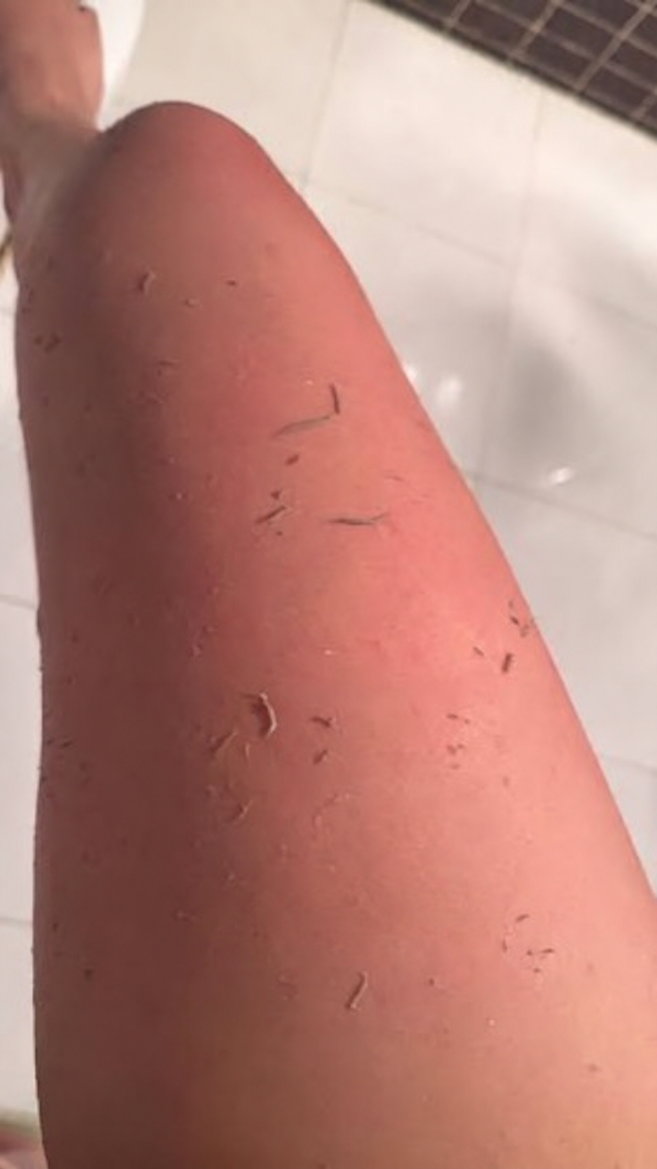 Dead skin lifted from a thigh in the shower